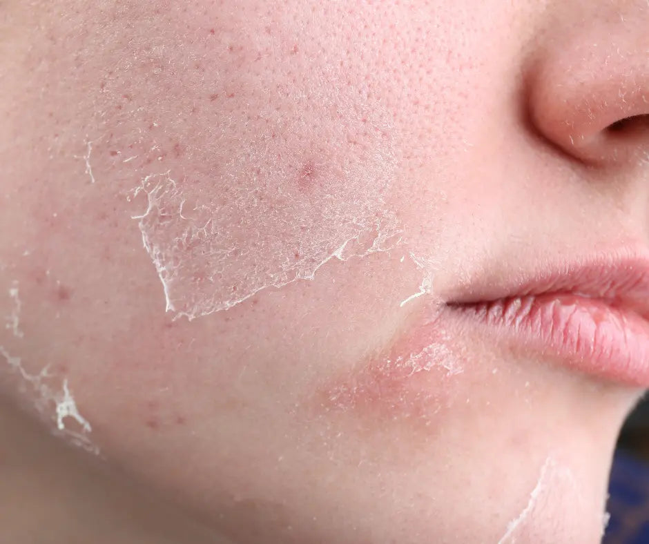 dry skin on face