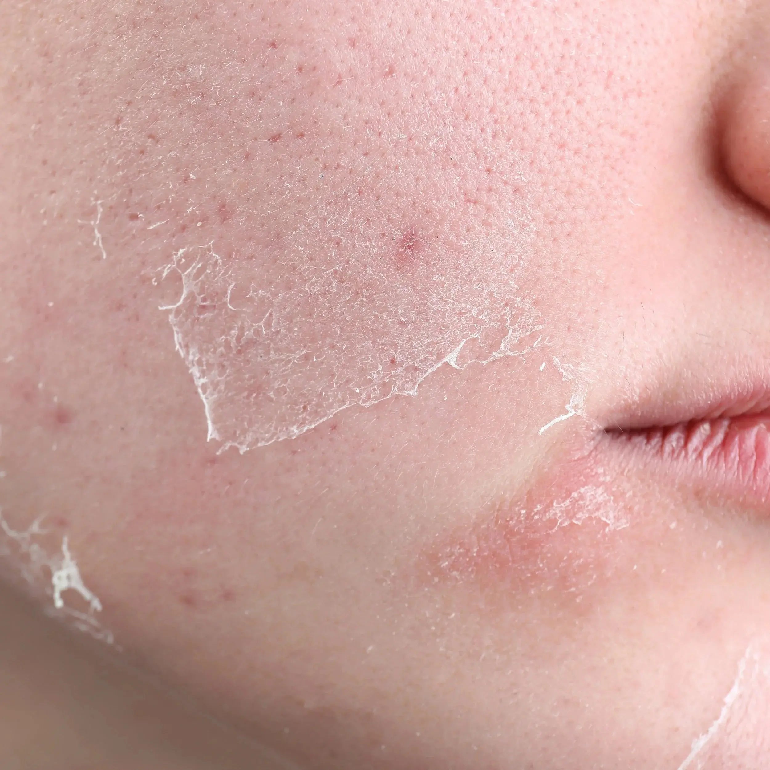 Dry-Skin Destinct