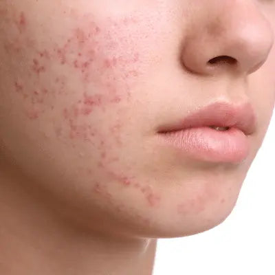 Acne Destinct