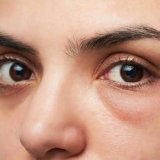 Eye-Bags Destinct