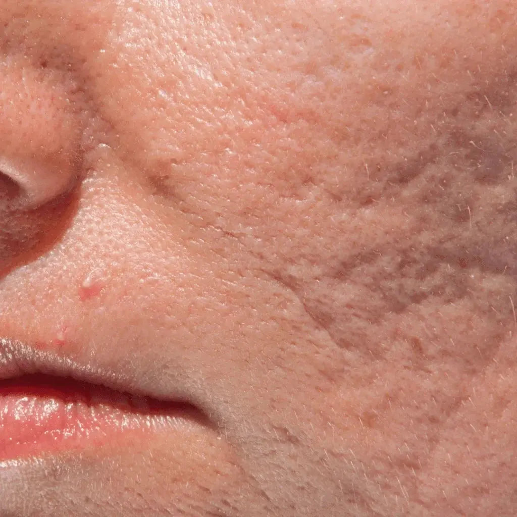 Acne-Scars Destinct